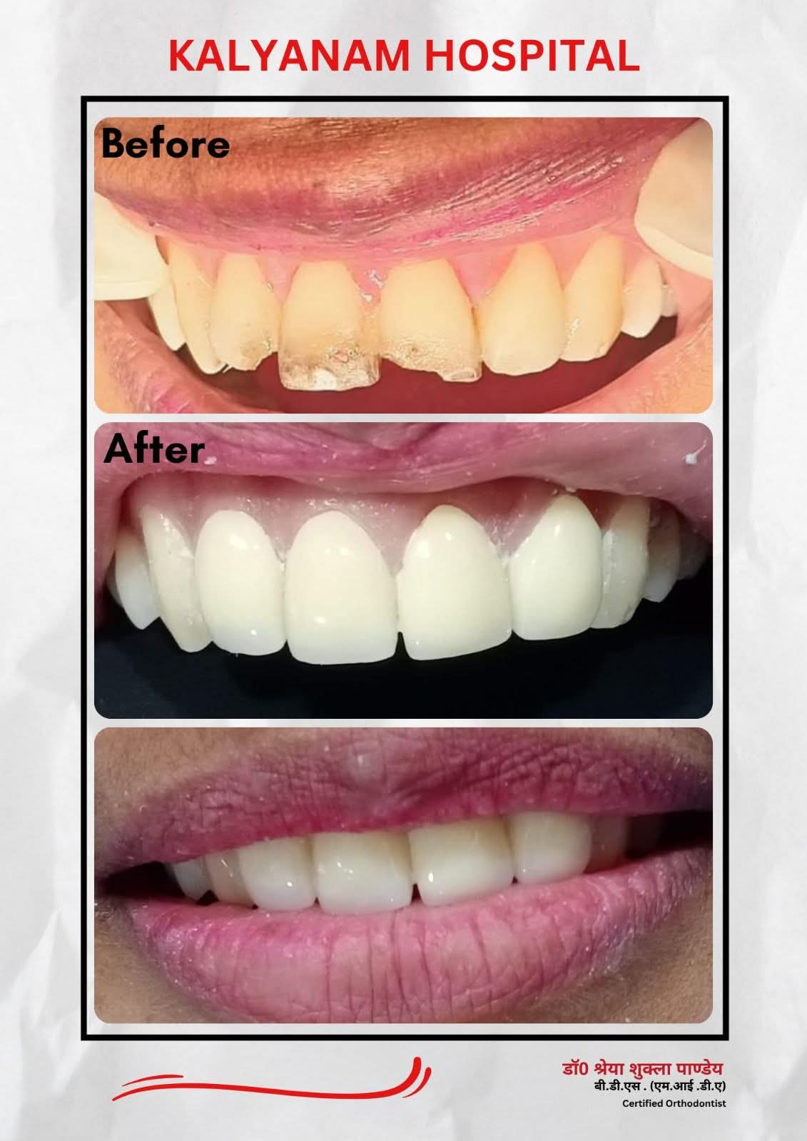 Dental before and after result