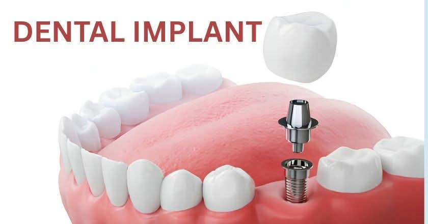 Dental implant service