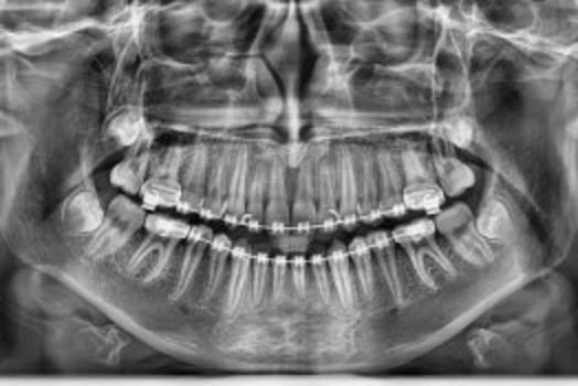 Panoramic dental x-ray